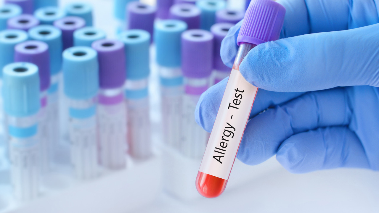 bir insanin diger insanlara karsi gercekten alerjisi olabilir mi OJxGMLPu.jpg